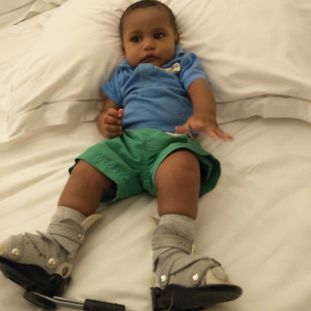 Baby Tiberius given a chance to walk through Mater Children’s Private Brisbane Clubfoot Clinic